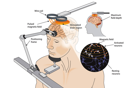 TMS explain with the help of Daigram